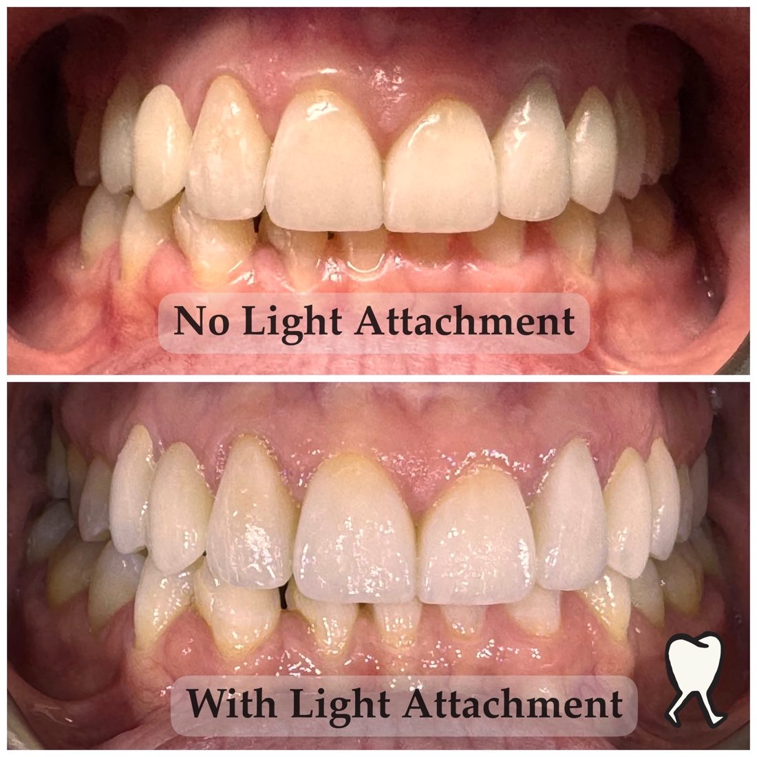 Retracted dental photo comparison with and without controlled light