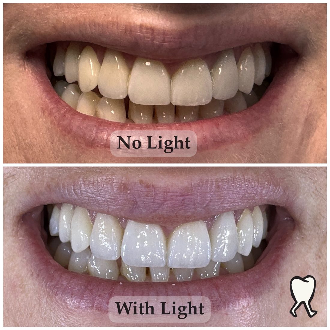 Smile photo comparison with and without a light attachment